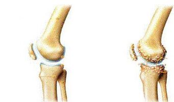 Symptoms of knee -based atrocysis
