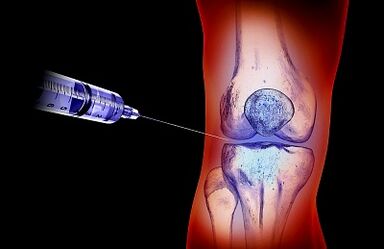 The treatment plan for arthrosis of the knee joint