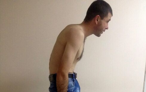 Ankylosing spondylitis can cause lower back pain over the years